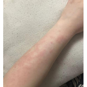 喝酒过敏起红疹怎么快速消除